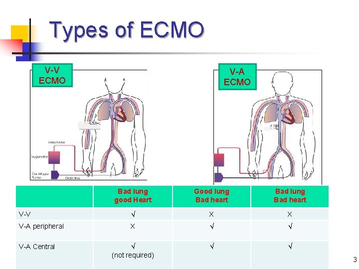 Types of ECMO V-V ECMO V-A ECMO Bad lung good Heart Good lung Bad
