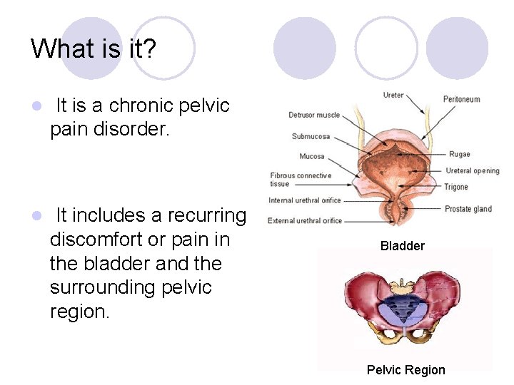 What is it? l It is a chronic pelvic pain disorder. l It includes