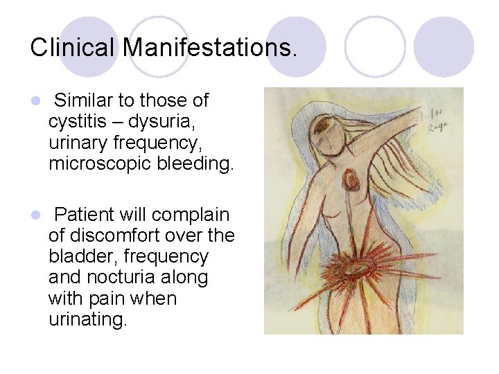 Clinical Manifestations. l Similar to those of cystitis – dysuria, urinary frequency, microscopic bleeding.