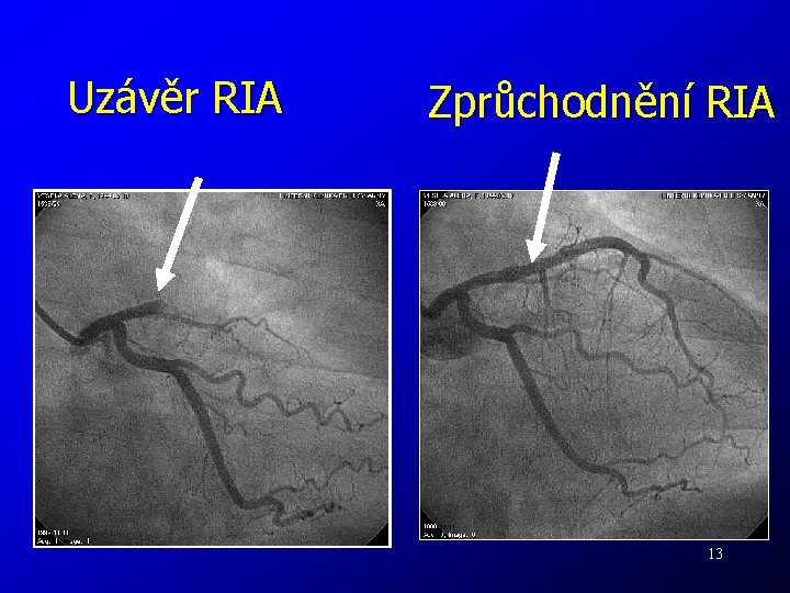 Uzávěr RIA Zprůchodnění RIA 13 