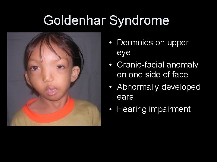 Goldenhar Syndrome • Photo of girl with • Dermoids on upper Goldenhar Syndrome, eye