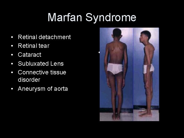 Marfan Syndrome • • • Retinal detachment Retinal tear Cataract Subluxated Lens Connective tissue