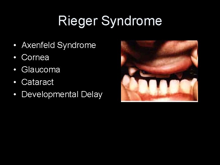 Rieger Syndrome • • • Axenfeld Syndrome Cornea Glaucoma Cataract Developmental Delay • Rieger