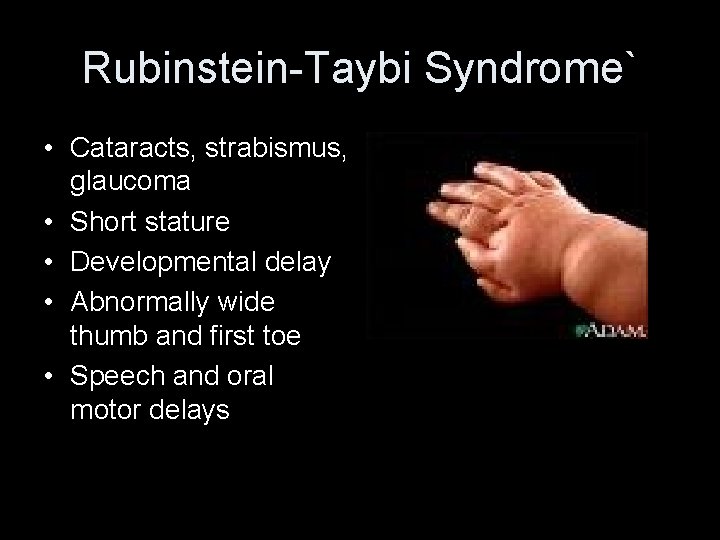 Rubinstein-Taybi Syndrome` • Cataracts, strabismus, • Photo of glaucoma Rubenstein-Taybi • Short stature •