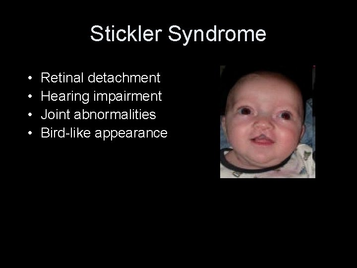 Stickler Syndrome • • Retinal detachment Hearing impairment Joint abnormalities Bird-like appearance • Photo