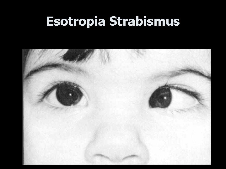 Esotropia Strabismus 