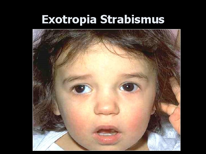 Exotropia Strabismus 