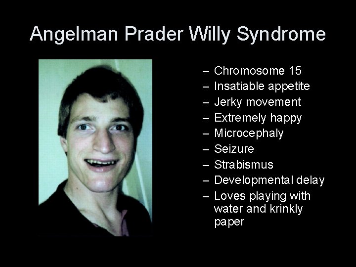 Angelman Prader Willy Syndrome • Photo of Angelman syndrome – – – – –