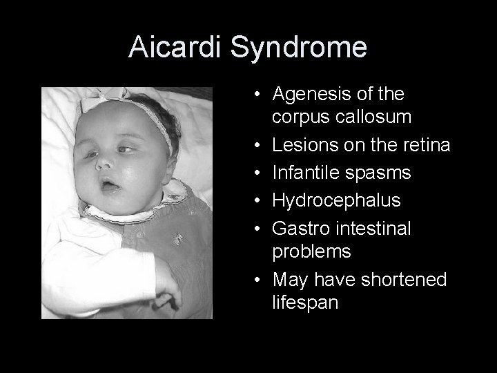 Aicardi Syndrome • Agenesis of the corpus callosum • Lesions on the retina •