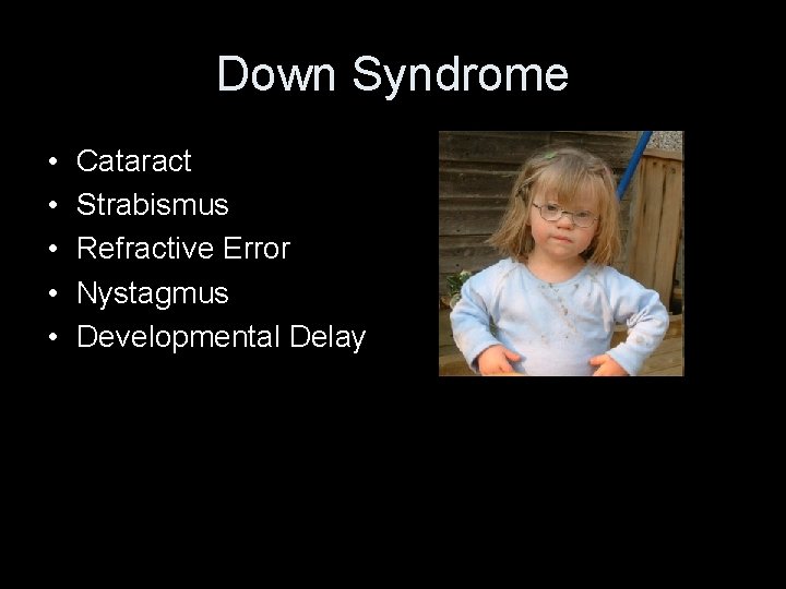 Down Syndrome • • • Cataract Strabismus Refractive Error Nystagmus Developmental Delay • Photograph