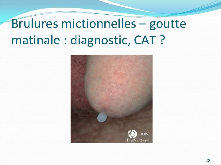 Brulures mictionnelles – goutte matinale : diagnostic, CAT ? 35 