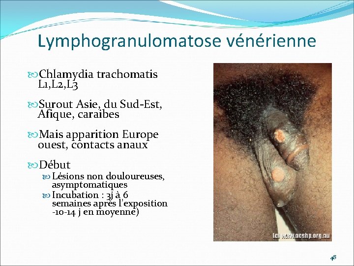 Lymphogranulomatose vénérienne Chlamydia trachomatis L 1, L 2, L 3 Surout Asie, du Sud-Est,