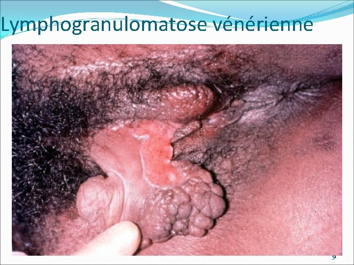 Lymphogranulomatose vénérienne 51 