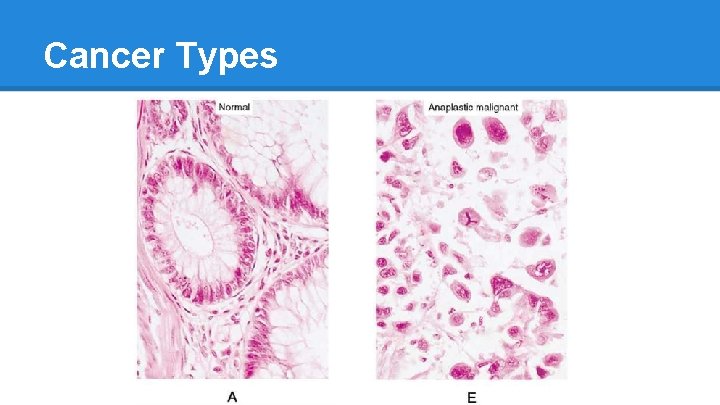 Cancer Types 