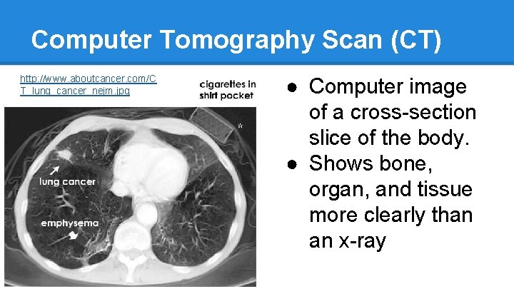 Computer Tomography Scan (CT) http: //www. aboutcancer. com/C T_lung_cancer_nejm. jpg ● Computer image of