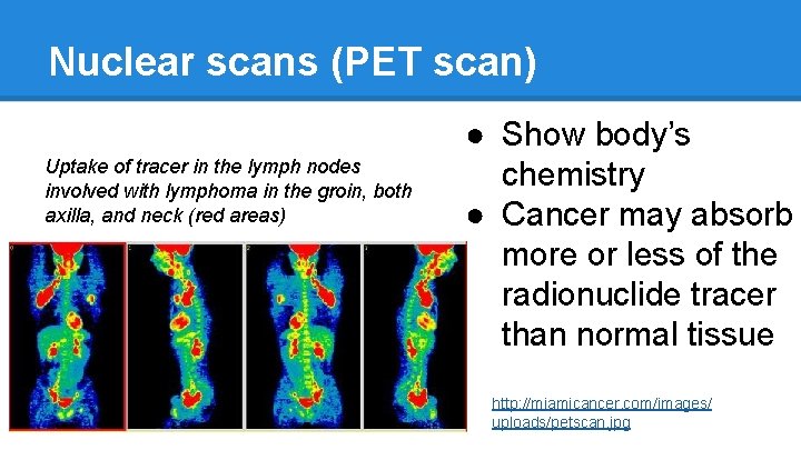 Nuclear scans (PET scan) Uptake of tracer in the lymph nodes involved with lymphoma