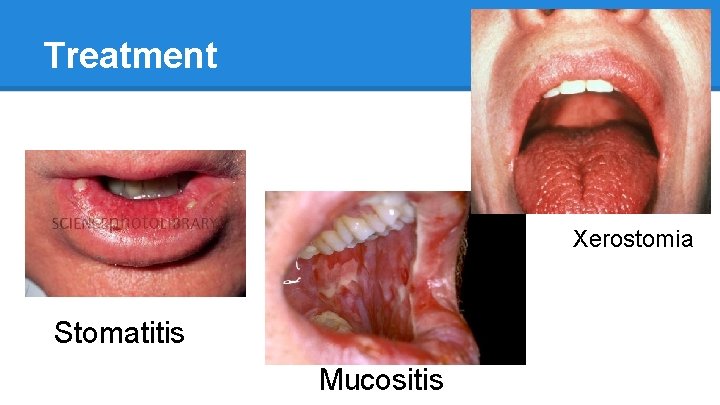 Treatment Xerostomia Stomatitis Mucositis 