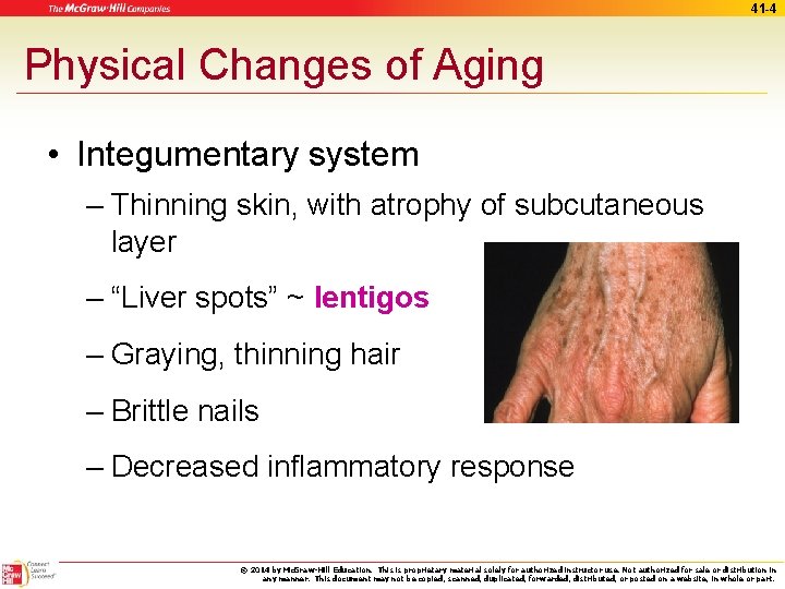 41 -4 Physical Changes of Aging • Integumentary system – Thinning skin, with atrophy