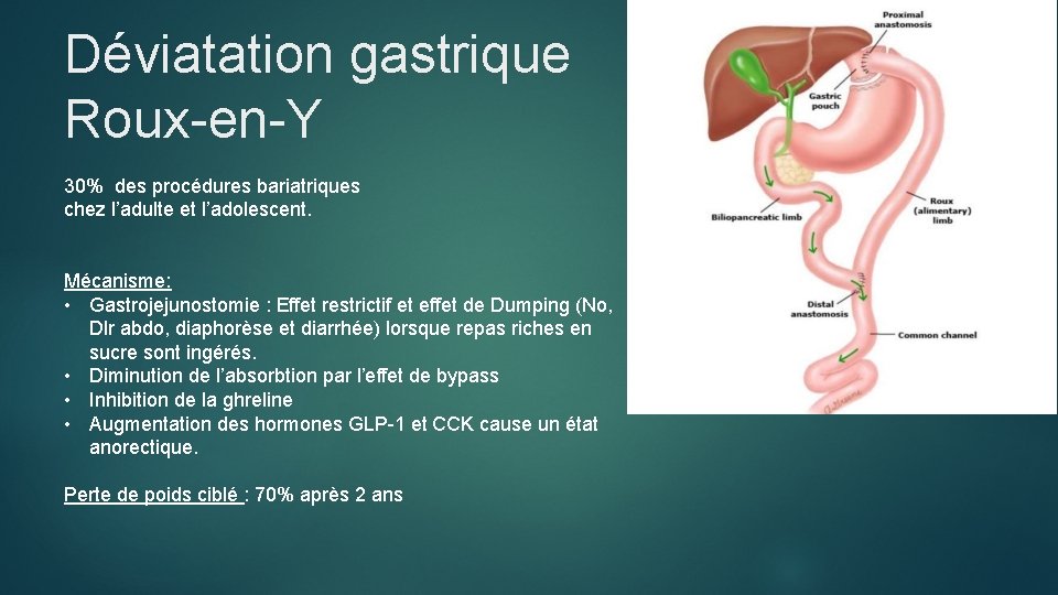 Déviatation gastrique Roux-en-Y 30% des procédures bariatriques chez l’adulte et l’adolescent. Mécanisme: • Gastrojejunostomie