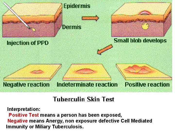 Interpretation: Positive Test means a person has been exposed, Negative means Anergy, non exposure