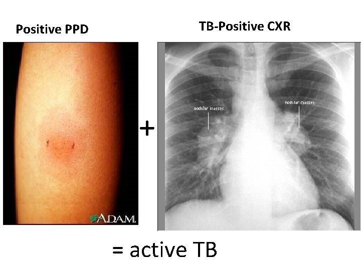 TB-Positive CXR Positive PPD + = active TB 
