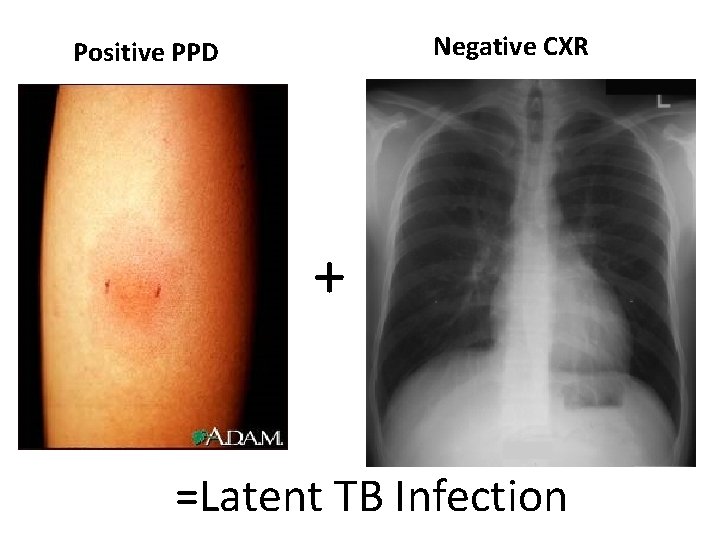 Negative CXR Positive PPD + =Latent TB Infection 
