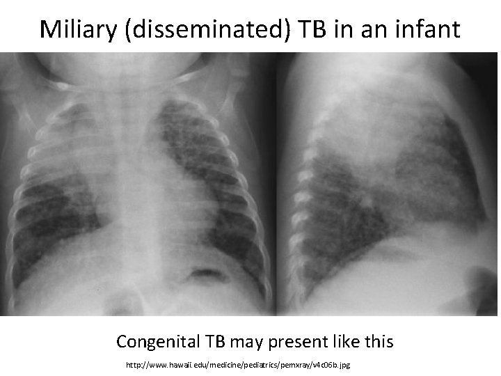 Miliary (disseminated) TB in an infant Congenital TB may present like this http: //www.