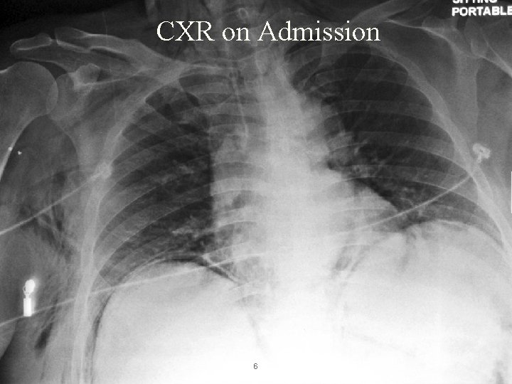 CXR on Admission 6 