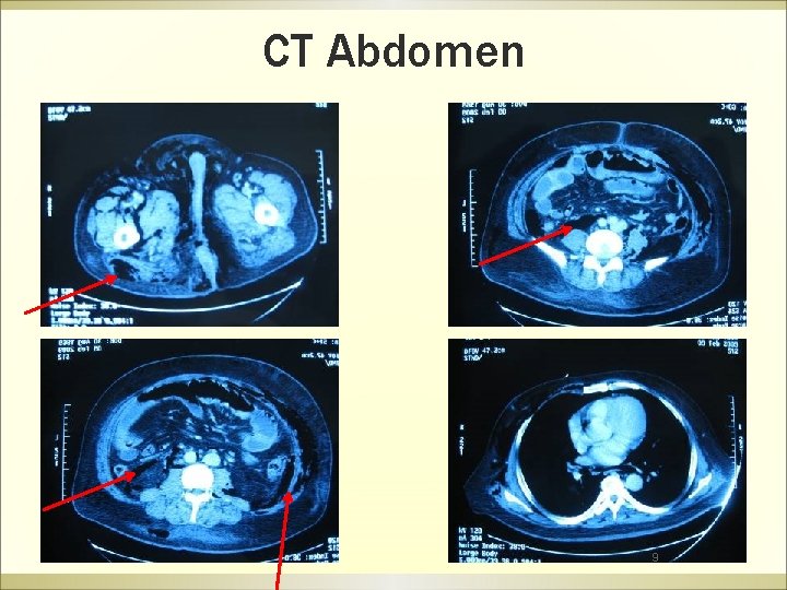 CT Abdomen 9 