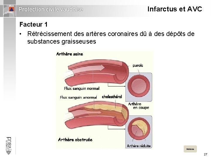 Infarctus et AVC Facteur 1 • Rétrécissement des artères coronaires dû à des dépôts
