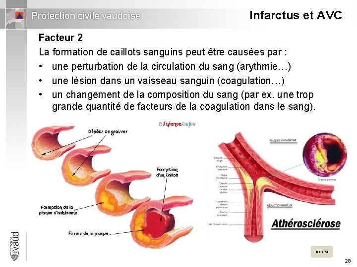 Infarctus et AVC Facteur 2 La formation de caillots sanguins peut être causées par