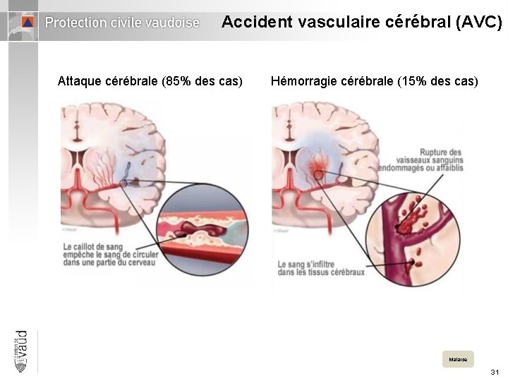 Accident vasculaire cérébral (AVC) Attaque cérébrale (85% des cas) Hémorragie cérébrale (15% des cas)