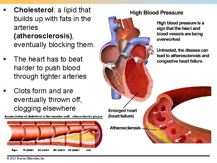 § Cholesterol: a lipid that builds up with fats in the arteries (atherosclerosis), eventually