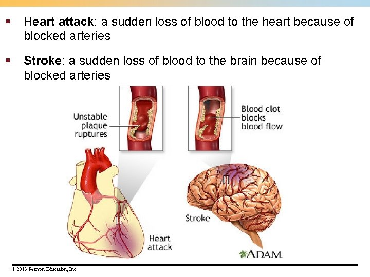 § Heart attack: a sudden loss of blood to the heart because of blocked