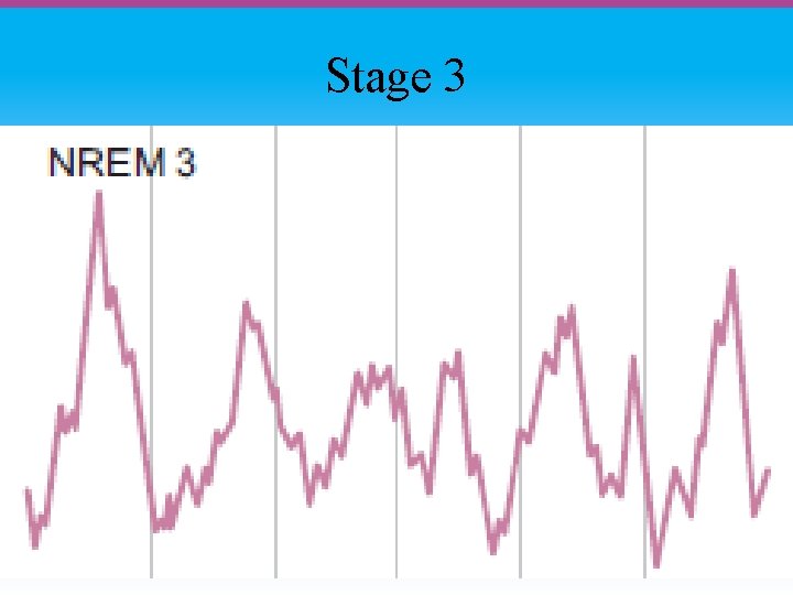 Stage 3 