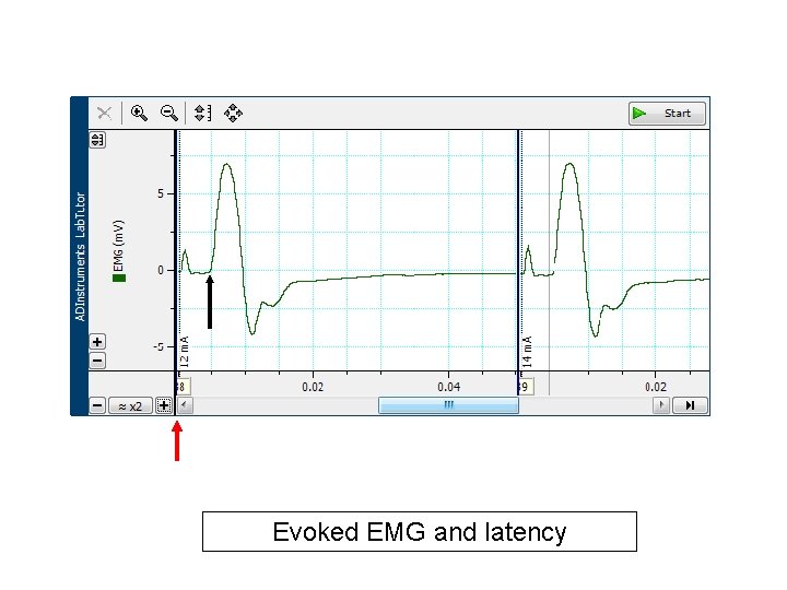 Evoked EMG and latency 