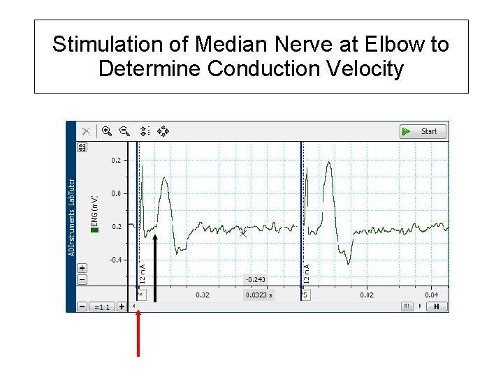 Stimulation of Median Nerve at Elbow to Determine Conduction Velocity 