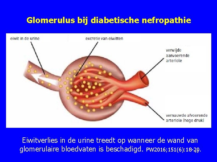 Glomerulus bij diabetische nefropathie Eiwitverlies in de urine treedt op wanneer de wand van