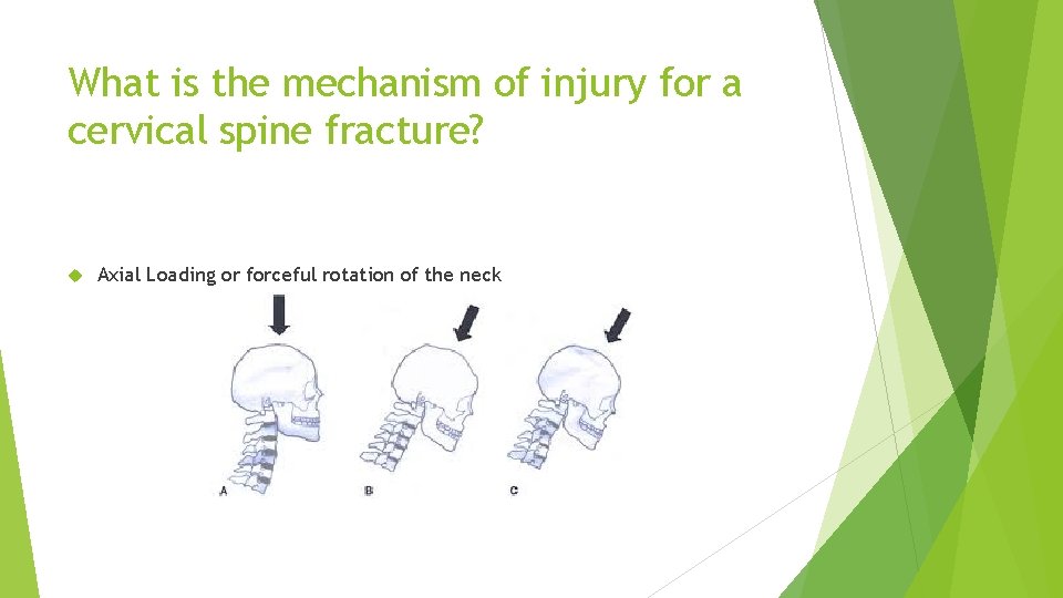 What is the mechanism of injury for a cervical spine fracture? Axial Loading or