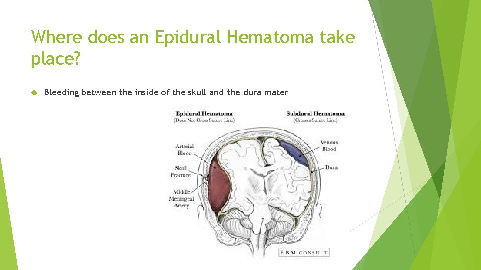 Where does an Epidural Hematoma take place? Bleeding between the inside of the skull