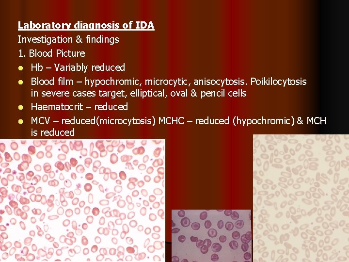 Laboratory diagnosis of IDA Investigation & findings 1. Blood Picture l Hb – Variably