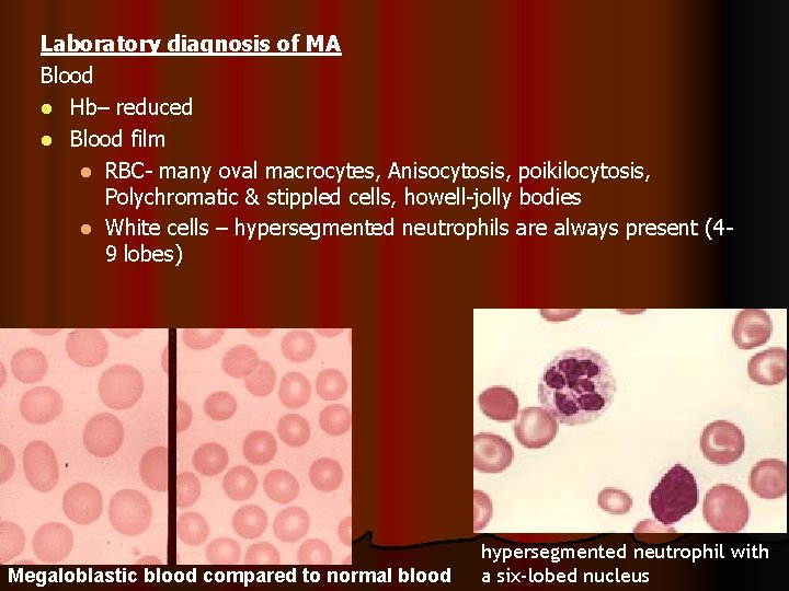 Laboratory diagnosis of MA Blood l Hb– reduced l Blood film l RBC- many