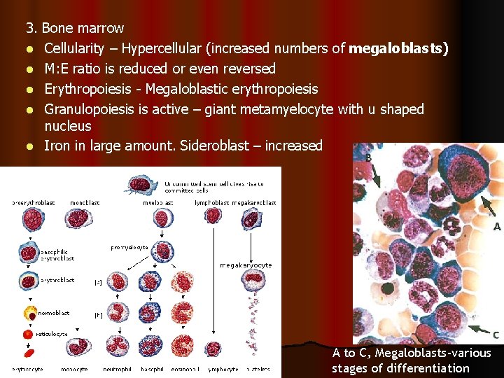 3. Bone marrow l Cellularity – Hypercellular (increased numbers of megaloblasts) l M: E