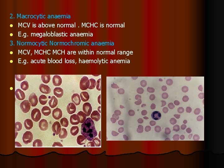 2. Macrocytic anaemia l MCV is above normal. MCHC is normal l E. g.