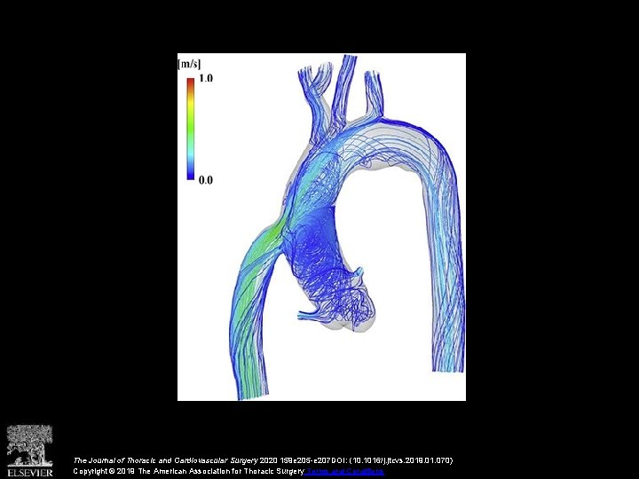 The Journal of Thoracic and Cardiovascular Surgery 2020 159 e 205 -e 207 DOI: