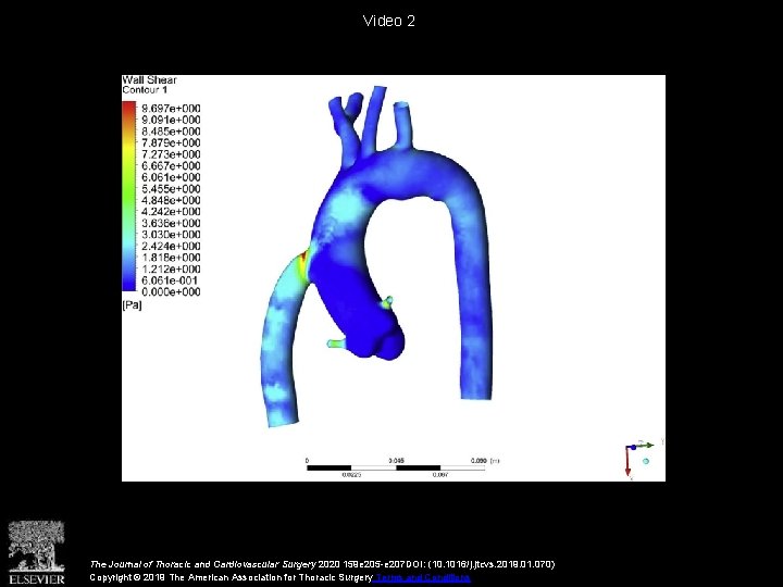 Video 2 The Journal of Thoracic and Cardiovascular Surgery 2020 159 e 205 -e