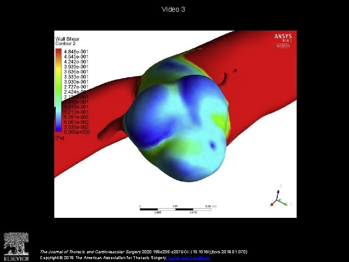 Video 3 The Journal of Thoracic and Cardiovascular Surgery 2020 159 e 205 -e