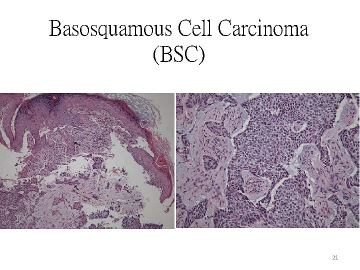 Basosquamous Cell Carcinoma (BSC) 21 Basosquamous Cell Carcinoma (BSC) 21