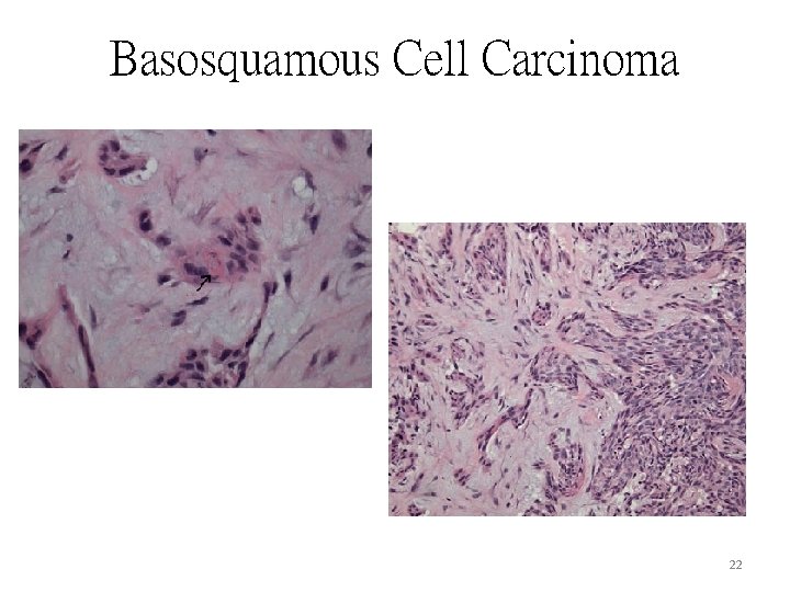 Basosquamous Cell Carcinoma 22 Basosquamous Cell Carcinoma 22