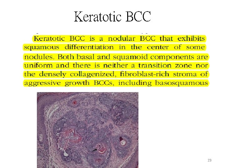 Keratotic BCC 23 Keratotic BCC 23